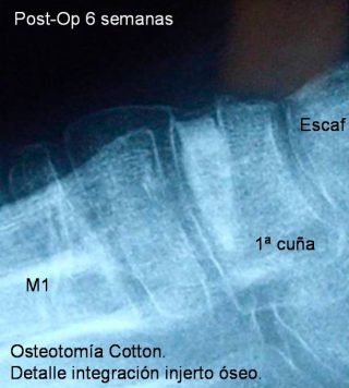 Osteotomía de Cotton