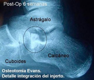 Osteotomía de Evans